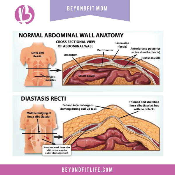 Diastasis Recti Anatomy